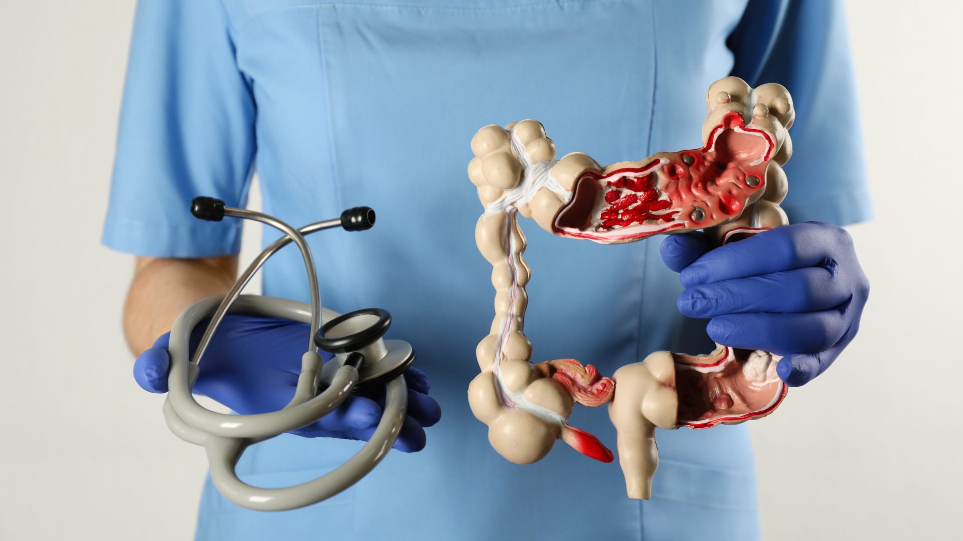 Cáncer colorrectal: Detectarlo a tiempo puede salvar tu vida 3