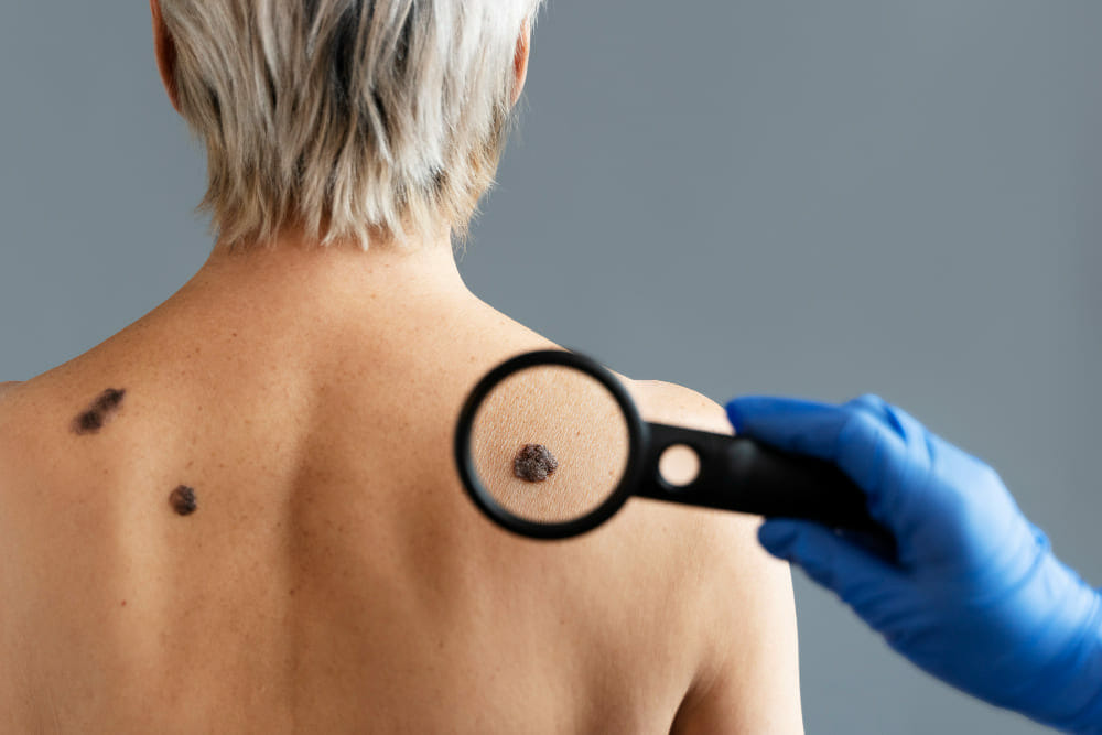 cómo prevenir cáncer de piel