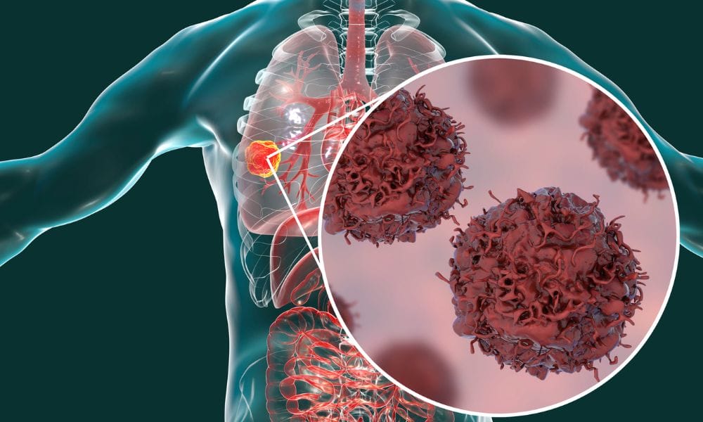 Biología del Cáncer de Pulmón