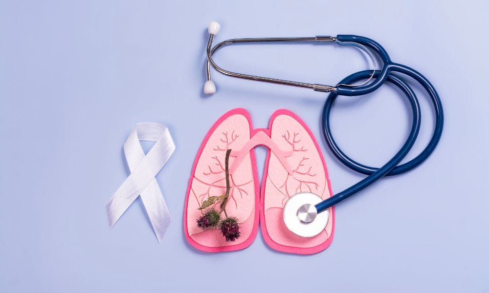 Factores de riesgo más comunes del cáncer de pulmón