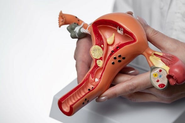 Cáncer de Ovario: un cáncer ginecológico silencioso