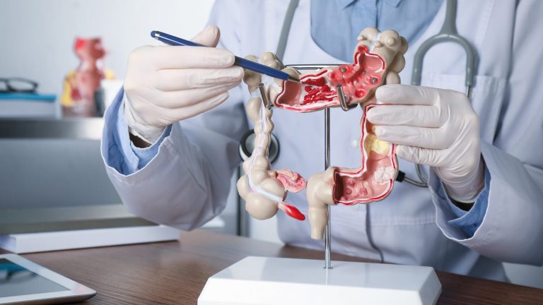 Cáncer de Colon: Síntomas y Prevención