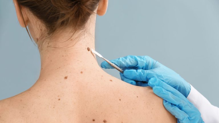 Cómo proteger tu piel del daño solar y prevenir el Cáncer de Piel